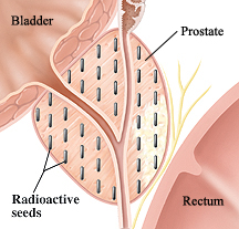 image of bladder