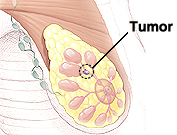 Cutaway view of breast with tumor