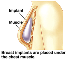 Cutaway view of breast implant