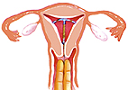 Image of IUD