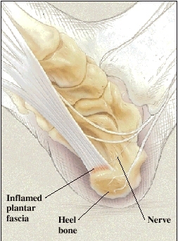 Cutaway view of heel
