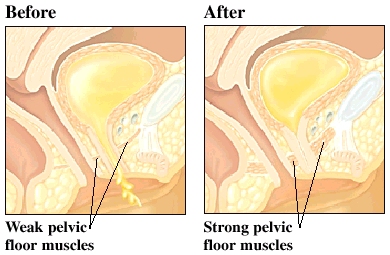 Images of strong and weak pelvic floors