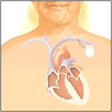 Cutaway view of heart