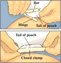 Image of clamping the pouch