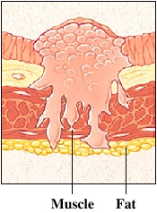 Cutaway view of bladder lining