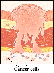 Cutaway view of bladder lining