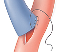 Image of artery graft