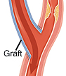 Once the bypass graft has been attached, blood can flow around the blockage