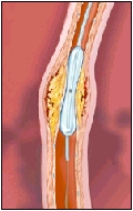 The balloon compresses the plaque against the artery wall