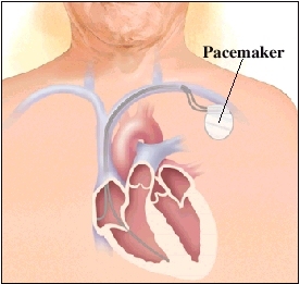 Image of pacemaker in body