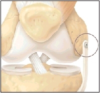 Cutaway view of knee