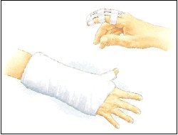 Image of cast and splints