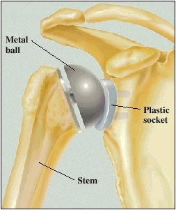 Cutaway view of shoulder with prosthesis