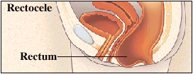 Cutaway view of rectum and vagina