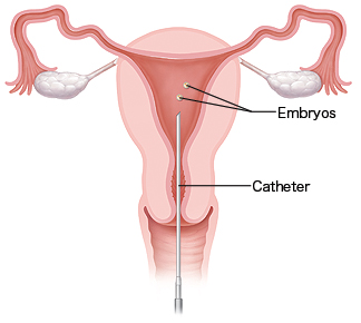 Cutaway view of the uterus