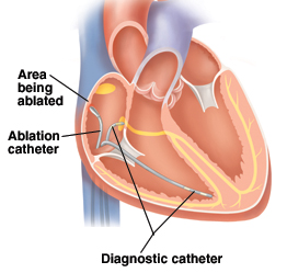 The catheters will be guided to the heart