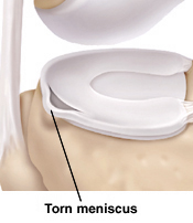 Image of meniscus