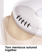 Image of meniscus surgery