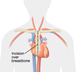 image of the placement of a chest incision
