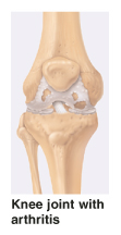 Image of knee joint with arthritis