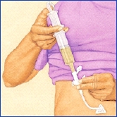 Image of procedure