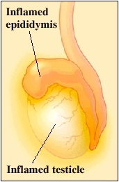 Inflamed testicle