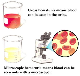 Image of bloody urine and microscope