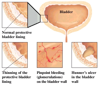 Cutaway views of bladder