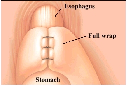 Image of esophagus