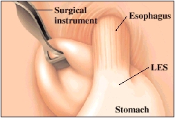 Image of esophagus
