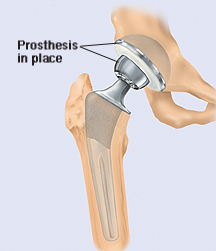 Cutaway view of hip with prosthesis