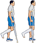 Image of man on crutches