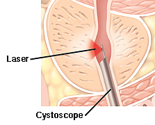 Cutaway view of prostate