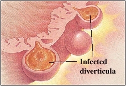 Image of infected diverticula