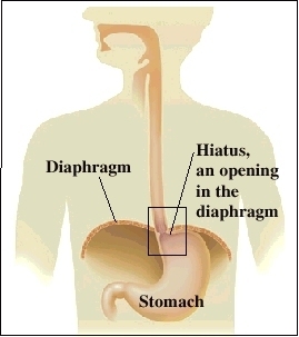 Imageof location of hiatal hernias