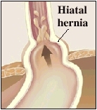 Image of a hiatal hernia