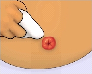 Cleaning skin around the stoma