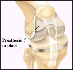 Image of prosthesis