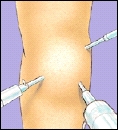 Arthroscope in knee