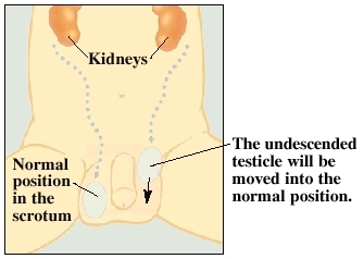 Cutaway view of undescended testicle