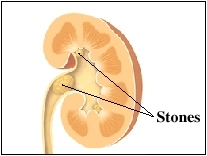 Image of kidney stones