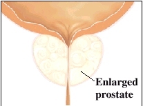 Image of prostate