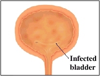 Image of bladder