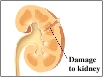 Image of damaged kidney