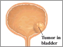Tumor in bladder
