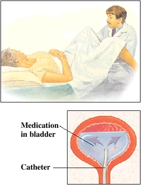 Images of patient undergoing procedure and cutaway view of bladder