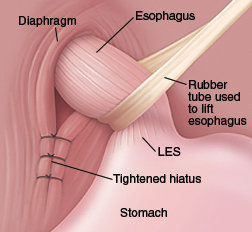 image of esophagus and diaphram