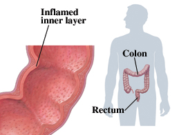 Cutaway view of colon and rectum